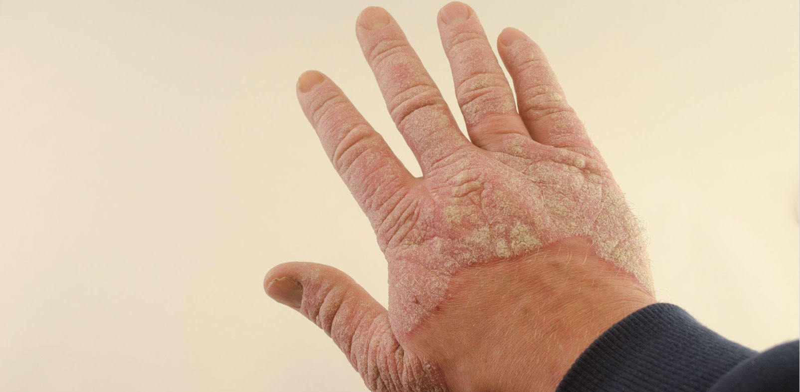 Psoriasis is a Deadly Skin Disease
