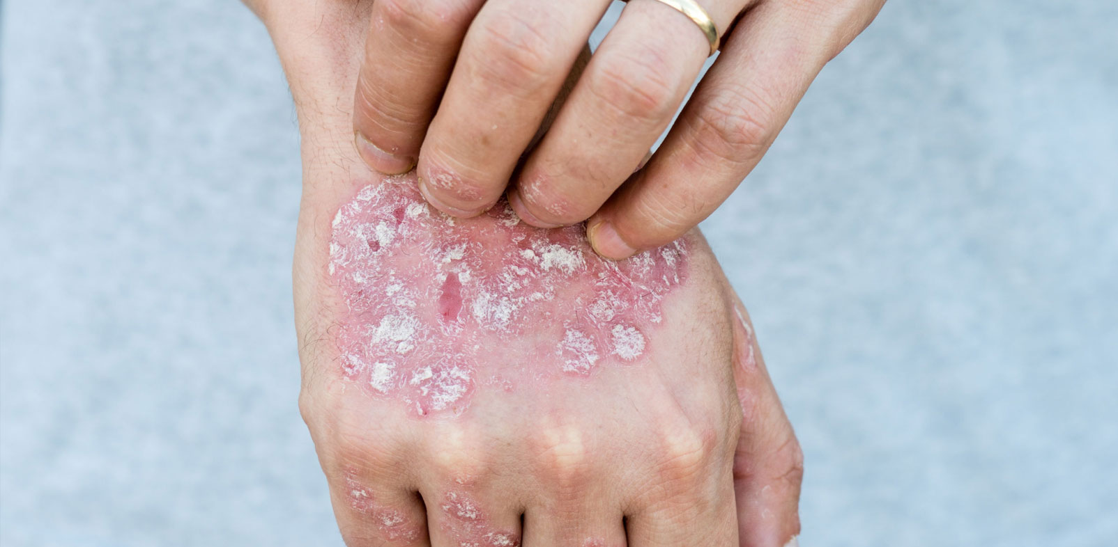  What are the Types of Psoriasis Creams to Treat a Patient?