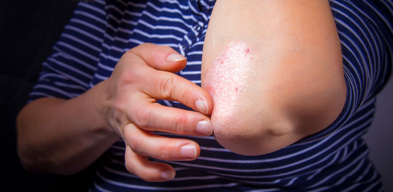 What are the Ways to Cure Psoriasis?